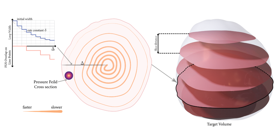 Spiral sonication trajectory on one layer with shrinking loop distance, velocity shown as path width, and the target volume sliced into layers.
